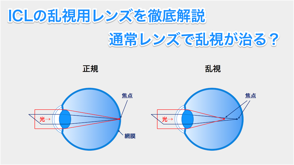 Iclの乱視用レンズを徹底解説 人によっては適用できないケースも Icl徹底解説 Iclの乱視用レンズを徹底解説 人によっては適用できないケースも Icl徹底解説