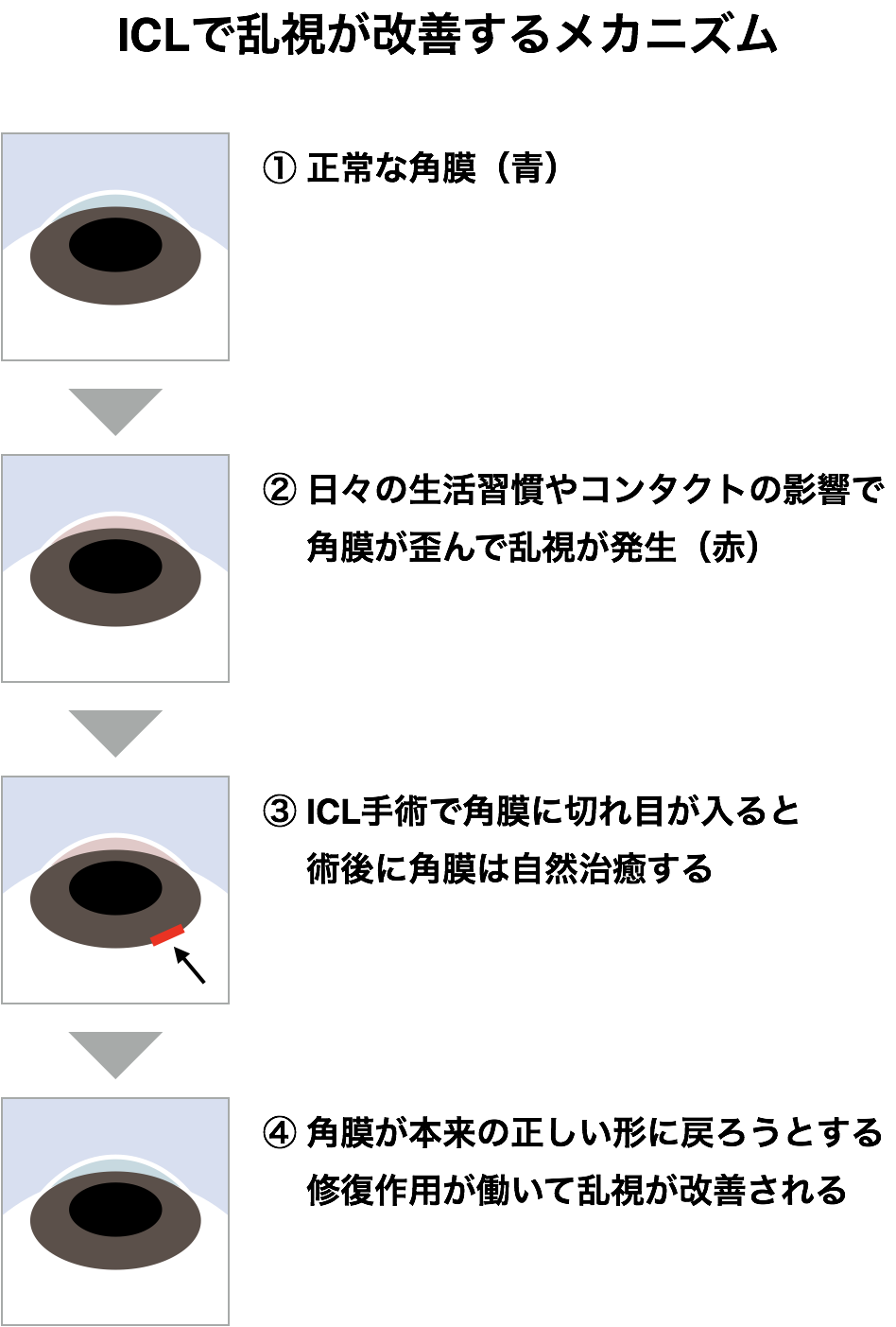 Iclの乱視レンズは適用できない人も メリット デメリットを徹底解説 Icl徹底解説